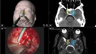 ¿Qué sucede durante la cirugía endoscópica endonasal de tumores de hipófisis y base de cráneo Pt4 [upl. by Luane]