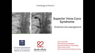 SVC syndrome Endovascular management [upl. by Weathers]