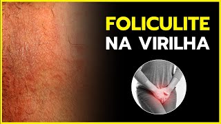 DICAS EFICAZES PARA ELIMINAR FOLICULITE NA VIRILHA VEJA AGORA [upl. by Joliet]