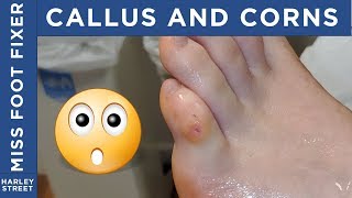 Corn and Callus non invasive removal By Miss Foot Fixer Marion Yau [upl. by Drusus]