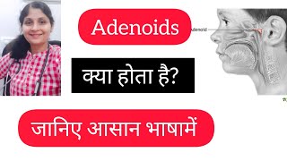 Adenoids explanation in easy language  Treatment  Homeopathy for Adenoids [upl. by Nilesoy]