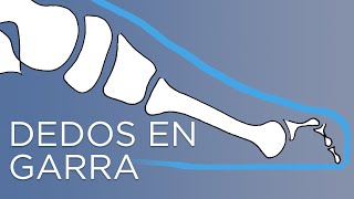 Dedos de los pies en garra  ¿Por qué tengo los dedos de los pies encogidos  IQTRA [upl. by Etnaud]