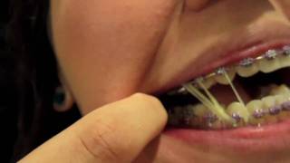 Braces Update  12 double elastics [upl. by Melone]