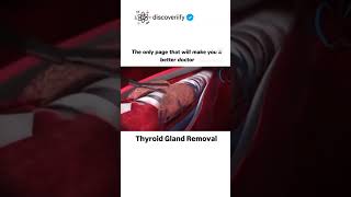 Thyroid gland removal [upl. by Perry371]