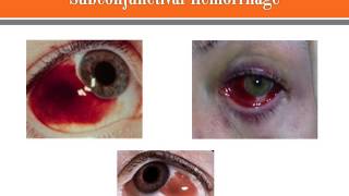 Subconjunctival Hemorrhage [upl. by Ikila964]