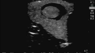 Thyroid Biopsy Ultrasound Training Model [upl. by Meit24]