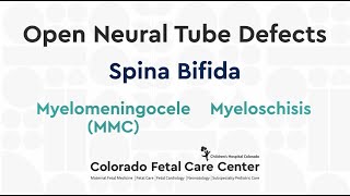 Spina Bifida Myelomeningocele MMC [upl. by Clovah]