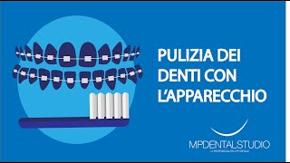 Come pulire i denti con lapparecchio fisso [upl. by Treblig]