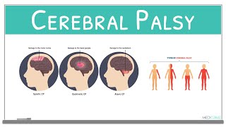 Cerebral Palsy classification causes signs and symptoms and treatment [upl. by Gnem]