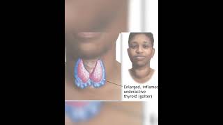 Learn Thyroid gland hypothyroidismclass 11 part2 trendingshortsneet science factseducation [upl. by Valenba]