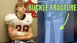 BROKEN ARM  BUCKLE  IMPACT FRACTURE WHAT IT IS amp WHAT IT MEANS FOR A YOUNG ATHLETE [upl. by Vonnie]