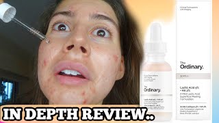 I TESTED THE ORDINARY LACTIC ACID FOR MY ACNE SCARS FOR 3 WEEKS THIS IS WHAT HAPPENED [upl. by Anglim]