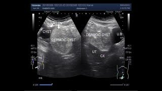 Ultrasound Video showing a simple ovarian cyst and a Dermoid ovarian cyst [upl. by Ennaisoj681]