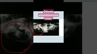 odontoameloblastomaoral pathologyameloblastic odontomaodontogenic tumor [upl. by Ile535]