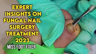 Expert Insights on Fungal Nail Surgery Restoring Healthy Nail by famous miss foot fixer [upl. by Fabe]