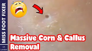 Massive Corn amp Callus Removal Full Treatment By Miss Foot Fixer [upl. by Ardnaxela]