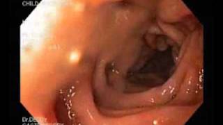 Gastroscopy  gastritis hyperemia and esophagitiswmv [upl. by Segal]