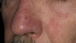 How to Treat Eczema on Face  Seborrheic Dermatitis Treatment  Face Eczema Treatment [upl. by Laemaj101]