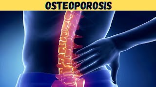 What is Osteoporosis 3d animation  pathophysiology symptoms causes  estrogen  old age  kya hindi [upl. by Uhile]