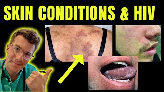 Doctor explains skin conditions associated with HIV  AIDS eg Kaposi sarcoma candida amp more [upl. by Aible]