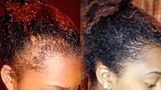 How to Regrow your Edges Bald Spots and Thinning Hair [upl. by Deibel]