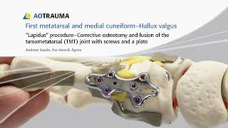 AO Lapidus procedure  corrective osteotomy and fusion of first TMT joint [upl. by Ryon]