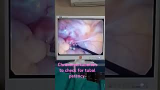 laparoscopic chromopertubation for checking tubal patencyhealthmedicalinfertility tube block [upl. by Notlaw]