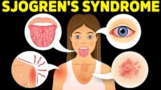 The Best Protocol for Sjogrens Syndrome [upl. by Luttrell881]