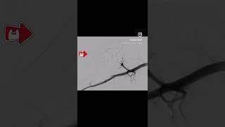 PAINFUL GROWING SWELLING ARTERIOVENOUS MALFORMATION TREATMENT BY embolization PINHOLE PROCEDURE [upl. by Ialokin610]