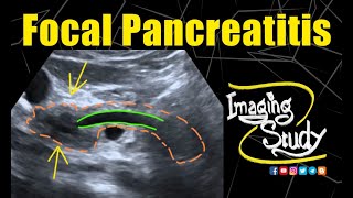 Focal Pancreatitis  Ultrasound  CT  Case 196 [upl. by Lledrac143]