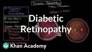 Diabetic retinopathy  Endocrine system diseases  NCLEXRN  Khan Academy [upl. by Olimac78]