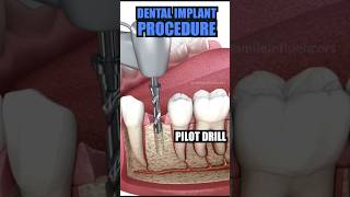 DENTAL IMPLANT 🦷 dentist trending dentisty viralvideo [upl. by Iclek801]