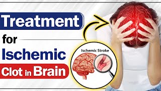 Treatment for Ischemic Clot in Brain  Ischemic Stroke in Paralysis  SRIAAS [upl. by Ecidnak932]