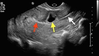 Non Tubal Ectopic Pregnancies [upl. by Ahsino]