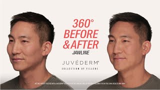 How to Instantly Improve Jawline Definition with JUVÉDERM® Filler  Mykol’s Before amp After [upl. by Lledraw]