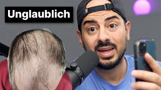 Er hatte eine Glatze 4500 Haarwurzeln amp 18 Monate änderten alles  Haartransplantation [upl. by Jareen]