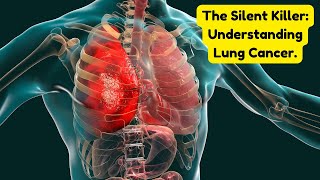 The Silent Killer Understanding Lung Cancer [upl. by Beckman101]