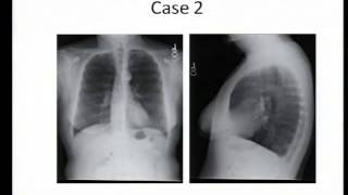 COPD A Review amp an Update 10114 [upl. by Xyla]