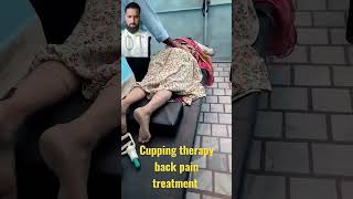 Cupping therapy back pain treatment physiotherapy cuppingtherapy chiropractic cupper viralshort [upl. by Luapnaej]