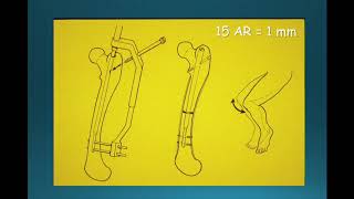 Allongement progressif des membres par clou centromédullaire [upl. by Rozek782]