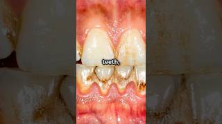 Gingivitis vs periodontistiswhats the difference [upl. by Ylekalb438]