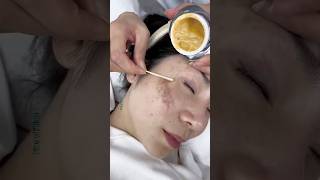 Remove Dark Spots amp Pigmentation Naturally At Home In 1WeekGet Glowing Skin Easily beauty shorts [upl. by Sezen]