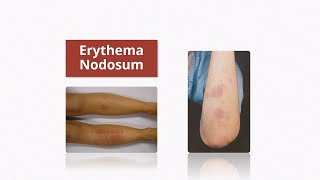 Erythema Nodosum  Causes amp Treatment [upl. by Aliac]