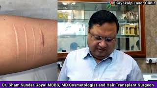 Arm Blade Cut Marks Removal Treatment  Arm Scar [upl. by Akym]