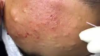 SUPER Removal of Cyst Acne on the Forehead at HIỀN VÂN SPA  Part 3  TRỊ MỤN HIỆU [upl. by Anig]