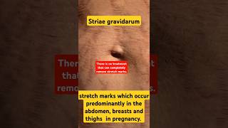 striae gravidarum how to remove stretch marksshorts youtubeshortstrending viralvideopregnancy [upl. by Eilesor961]