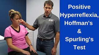 Positive Hoffmans Sign Hyperreflexia and Spurlings Test [upl. by Tugman]