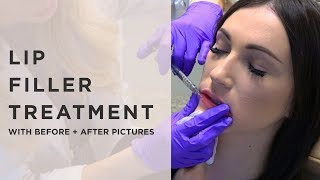 Lip Filler Treatment Demo with Before and Afters [upl. by Snodgrass]