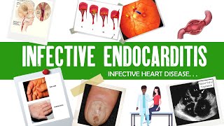 Infective Endocarditis  Dukes criteria  definition causes symptoms complications amp treatment [upl. by Maro]