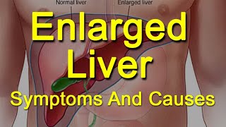 Enlarged Liver Symptoms And Causes  What Is Hepatomegaly [upl. by Anahcar]